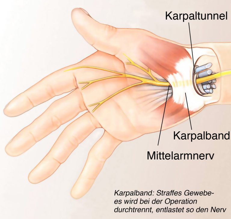 curacarpal 